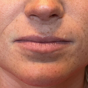 Lip Filler Before and After Photo by Coachlight Clinic Spa in West Des Moines Iowa