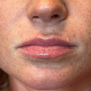 Lip Filler Before and After Photo by Coachlight Clinic Spa in West Des Moines Iowa