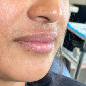 Lip Filler Before and After Photo by Coachlight Clinic Spa in West Des Moines Iowa