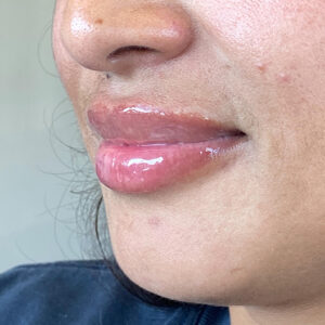 Lip Filler Before and After Photo by Coachlight Clinic Spa in West Des Moines Iowa