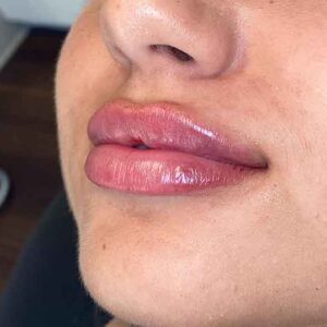 Lip Filler Before and After Photo by Coachlight Clinic & Spa in West Des Moines Iowa